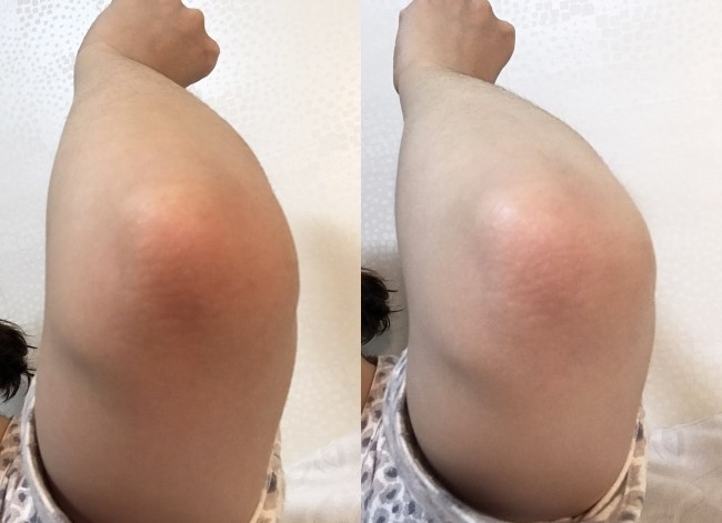 New elbow armpit pigmentation stinging body whole 