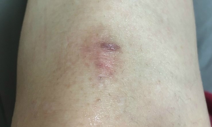 New spiny freckles Elbow pigmentation ENEC Course 