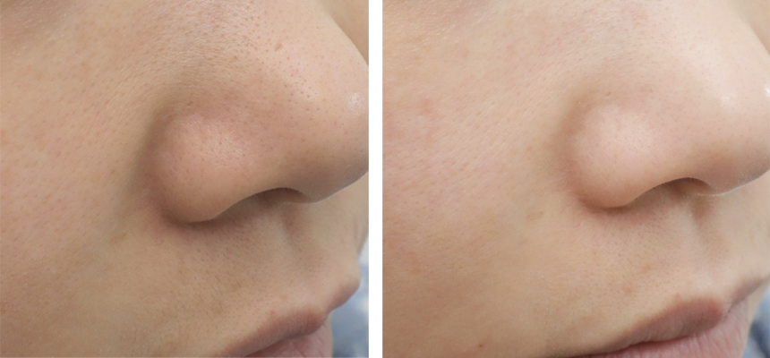 NEW PORE MASK See Mud Green PurePack Acne Pore Man